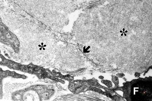 M,60y. | jejunum - amyloidosis M,60y. | jejunum - amyloidosis
